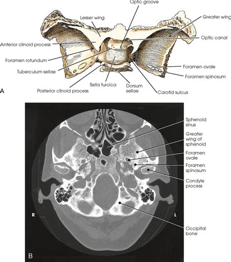 SKULL | Radiology Key