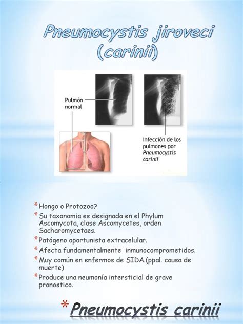 Pneumocystis Jiroveci | PDF | Neumonía | Medicina