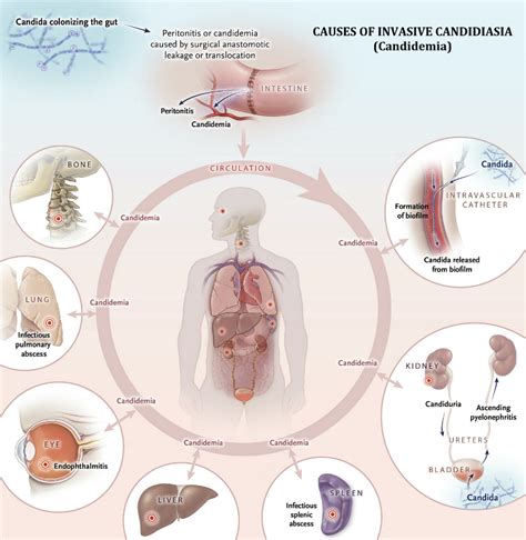 Invasive Candidiasis - Health And Medical Information