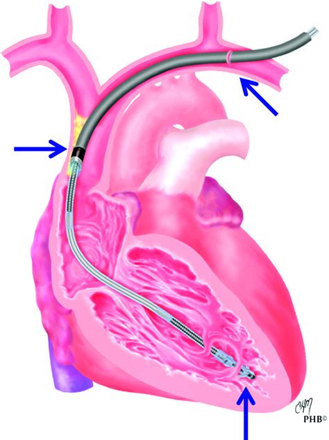 Pacemaker and Defibrillator Lead Extraction | Circulation