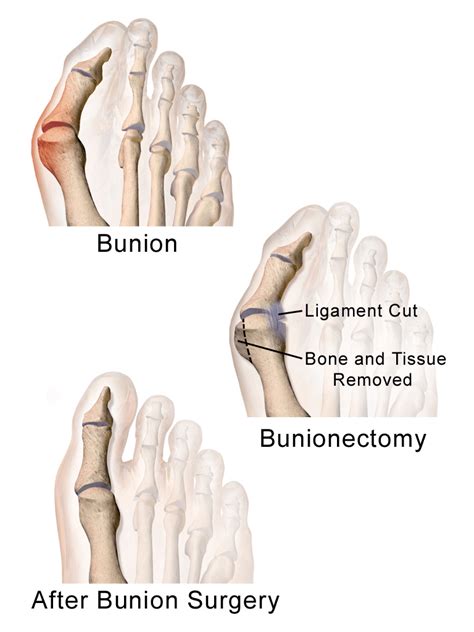 Bunionectomy | Bunion Surgery | Bunionectomy Recovery | Cost - Sutured