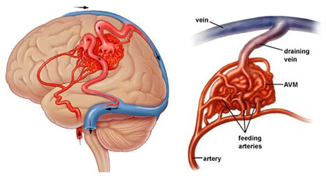 Brain Vascular Malformation Symptoms & Treatment | Stroke & Aneurysm Center