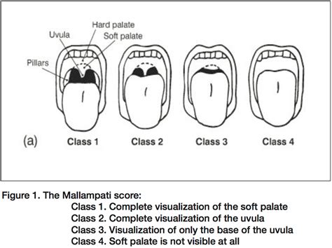 Mallampati Airway Score