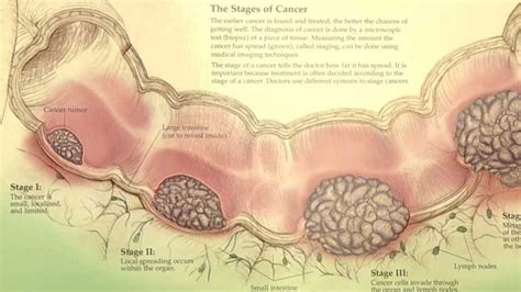 Symptoms of colorectal cancer and the importance of catching it early | WYTV