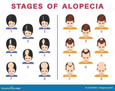 Stages of Alopecia in Men and Women Vector Illustrations Set Stock ...