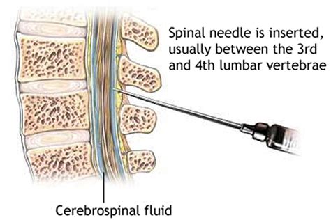 Lumbar Puncture Procedure - Position & Lumbar Puncture Side Effects