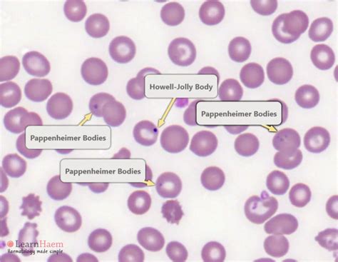 Howell-Jolly Bodies - LearnHaem | Haematology Made Simple