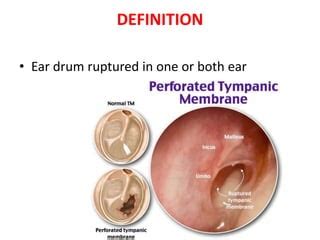 Ruptured Tympanic Membrane Trauma