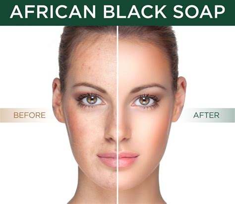 Before And After Black Soap | ubicaciondepersonas.cdmx.gob.mx