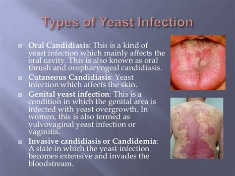 Tratamiento candidiasis dosis unica, yeast infection probiotics, cure ...