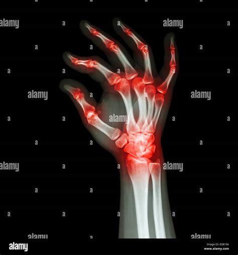 "Rheumatoid Arthritis , Gouty Arthritis" (X-ray adult's hand with ...