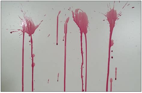 Arterial Spray Blood Spatter