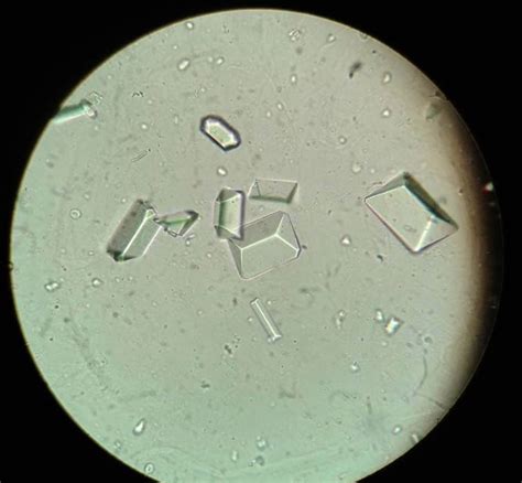 Triple Phosphate Crystals in Urine Sediment | Medical Laboratories