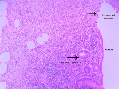 Acute Appendicitis – Histopathology.guru