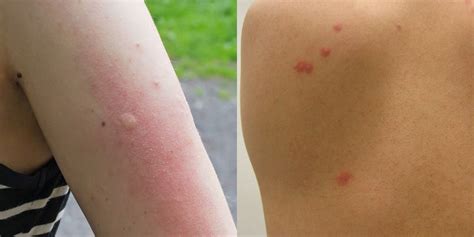 Bed Bug Bites Vs. Mosquito Bites: What's the Difference? - Business Insider