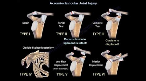 Acromioclavicular Joint Injury — OrthopaedicPrinciples.com