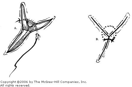 bleeding - Dealing with triangle puncture wounds - Health Stack Exchange