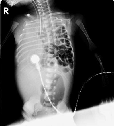 Scaphoid Abdomen X Ray - Choose from 500 different sets of flashcards about positioning x ray ...