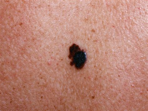 Skin Cancer - Types, Symptoms - Melanoma & Treatment