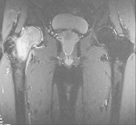 Femoral Neck Edema Mri