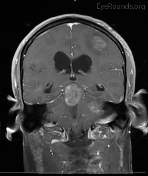 Bilateral Internuclear Ophthalmoplegia and Thalamic Esotropia: The ...