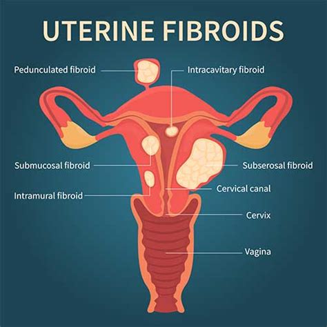 Intramural Fibroids – What are they? Symptoms, Causes, Diagnosis and Treatment – Dr. Deepa Ganesh