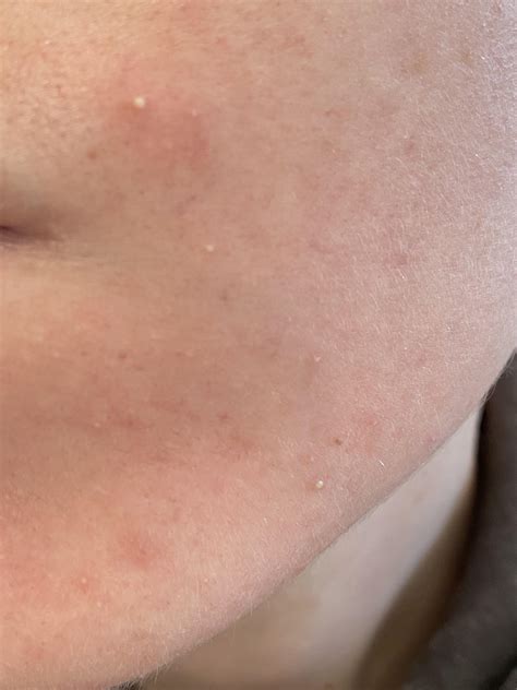 Do anyone’s pustules look like this? I have them on the other side as well and on my jawline. I ...