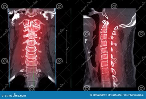 CT SCAN of Cervical Spine C-spine Stock Illustration - Illustration of case, head: 250522500