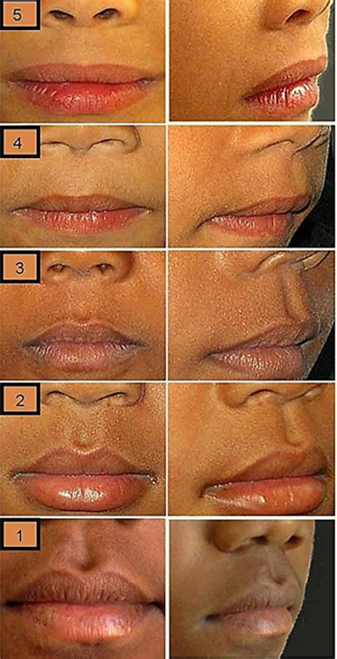 Philtrum of lip, causes of smooth philtrum, long or short philtrum