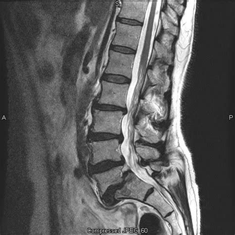 mri procedures and pathology: lumbar spondylolisthesis