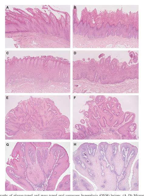 Figure 1 from Oral verrucous hyperplasia: histologic classification, prognosis, and clinical ...