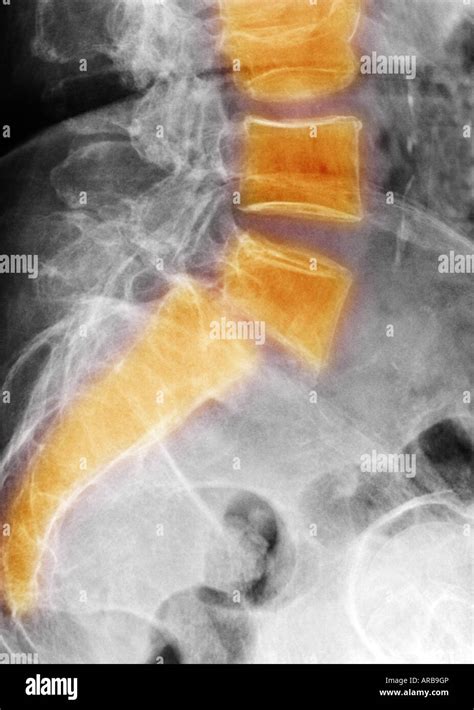 Lumbar spine xray showing a grade II anterolisthesis of L5 on S1 Stock Photo: 15999957 - Alamy