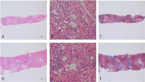 Liver Biopsy at First Evaluation and Repeated Biopsy Four Years Later.... | Download Scientific ...