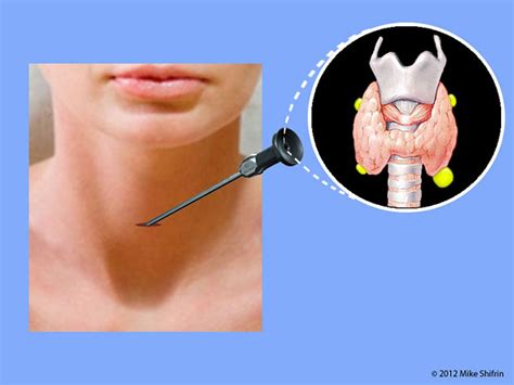 Minimally Invasive Parathyroid Surgery. | www.Parathyroid-Surgeon.com