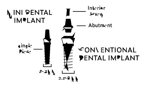 Tooth Implant Types