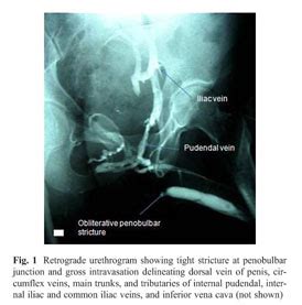 Retrograde urethrogram or a venogram? Be careful next time - Document ...