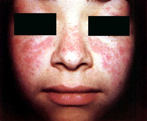 👉 Systemic Lupus Erythematosus - Pictures, Symptoms, Causes, Treatment ...