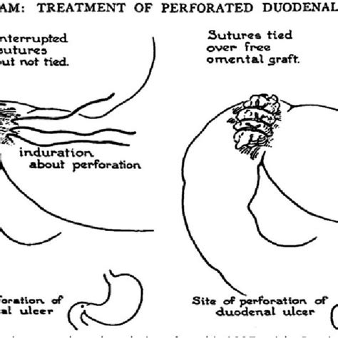 Schematic diagram of omental (Graham) patch technique (plugging with... | Download Scientific ...