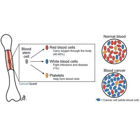 Leukemia | CancerQuest