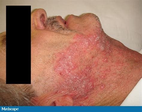 Persistent Facial "Dermatitis"