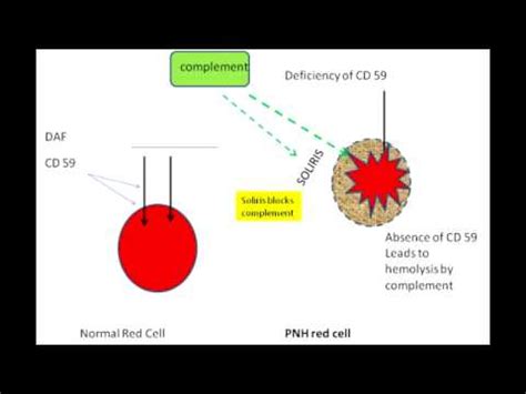 Paroxysmal Nocturnal Hemoglobinuria - YouTube