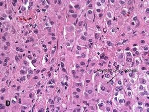 American Urological Association - Leydig Cell Tumor