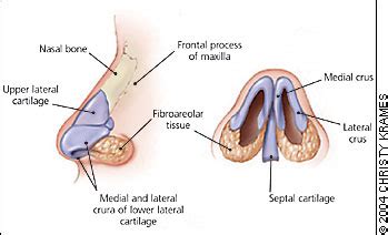 Learning Radiology - Fracture of the Nasal Bone, Nose