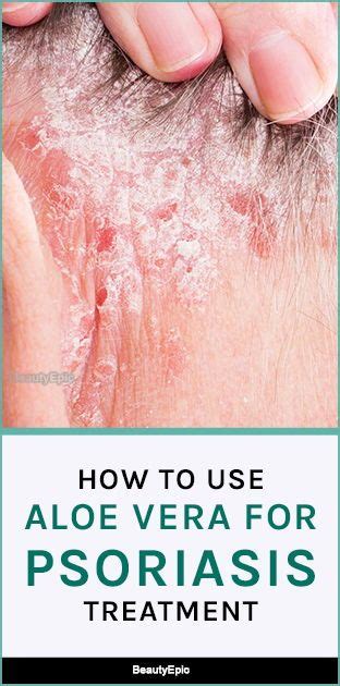 Aloe Vera for Psoriasis: How to Use? | Psoriasis, Nutrition healthy ...