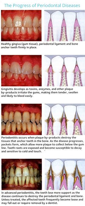 Gum Disease Therapy - Virginia Family DentalVirginia Family Dental