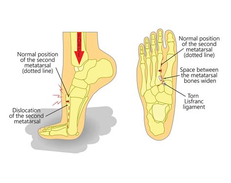 Lisfranc Injury - Upswing Health | Upswing Health