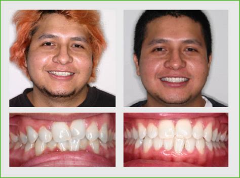 Invisalign Before and After – Orlando, FL