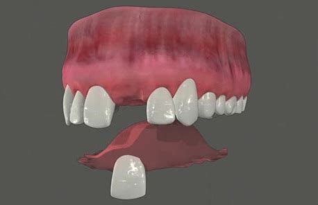 Crystal Lake Dental's Hot topics: Temproary partial denture Crystal Lake Dentist