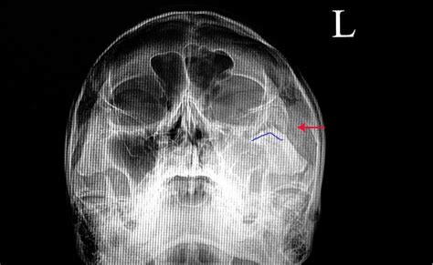 Zygomatic Bone - The Definitive Guide | Biology Dictionary