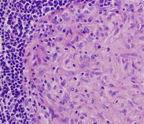 High power view of a tuberculous granuloma with mast cells ...